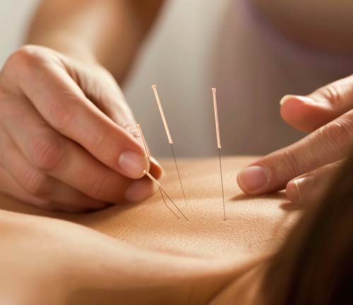 curso de acupuntura en Madrid